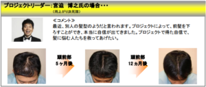 宮迫博之の薄毛治療