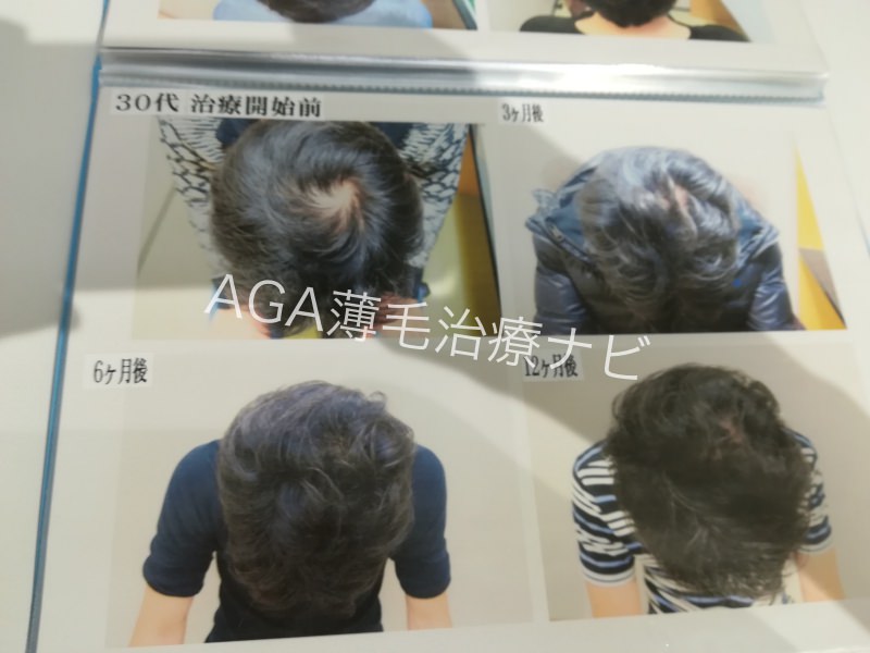 【AGA治療体験談】AGAスキンクリニックの発毛効果や費用を報告