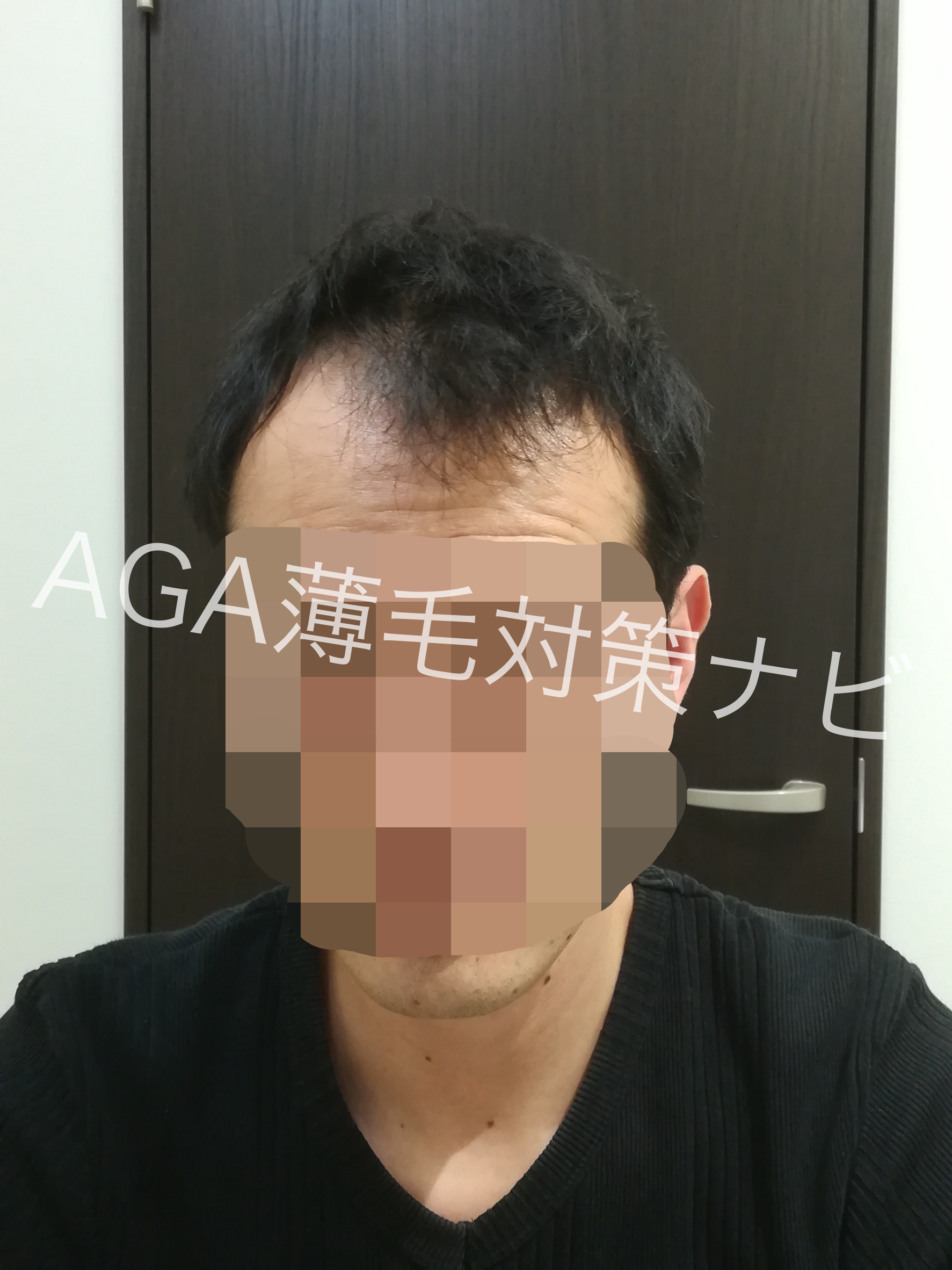 【体験談】AGAスキンクリニックの無料カウンセリング診断を体験!