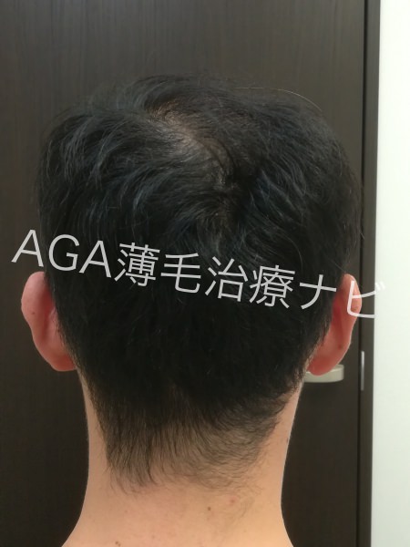 【AGA治療体験談】AGAスキンクリニックの発毛効果や費用を報告