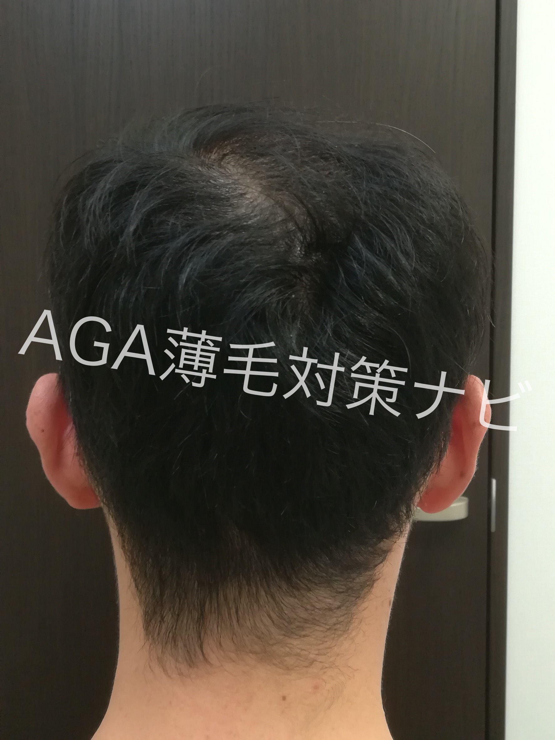【体験談】AGAスキンクリニックの無料カウンセリング診断を体験!