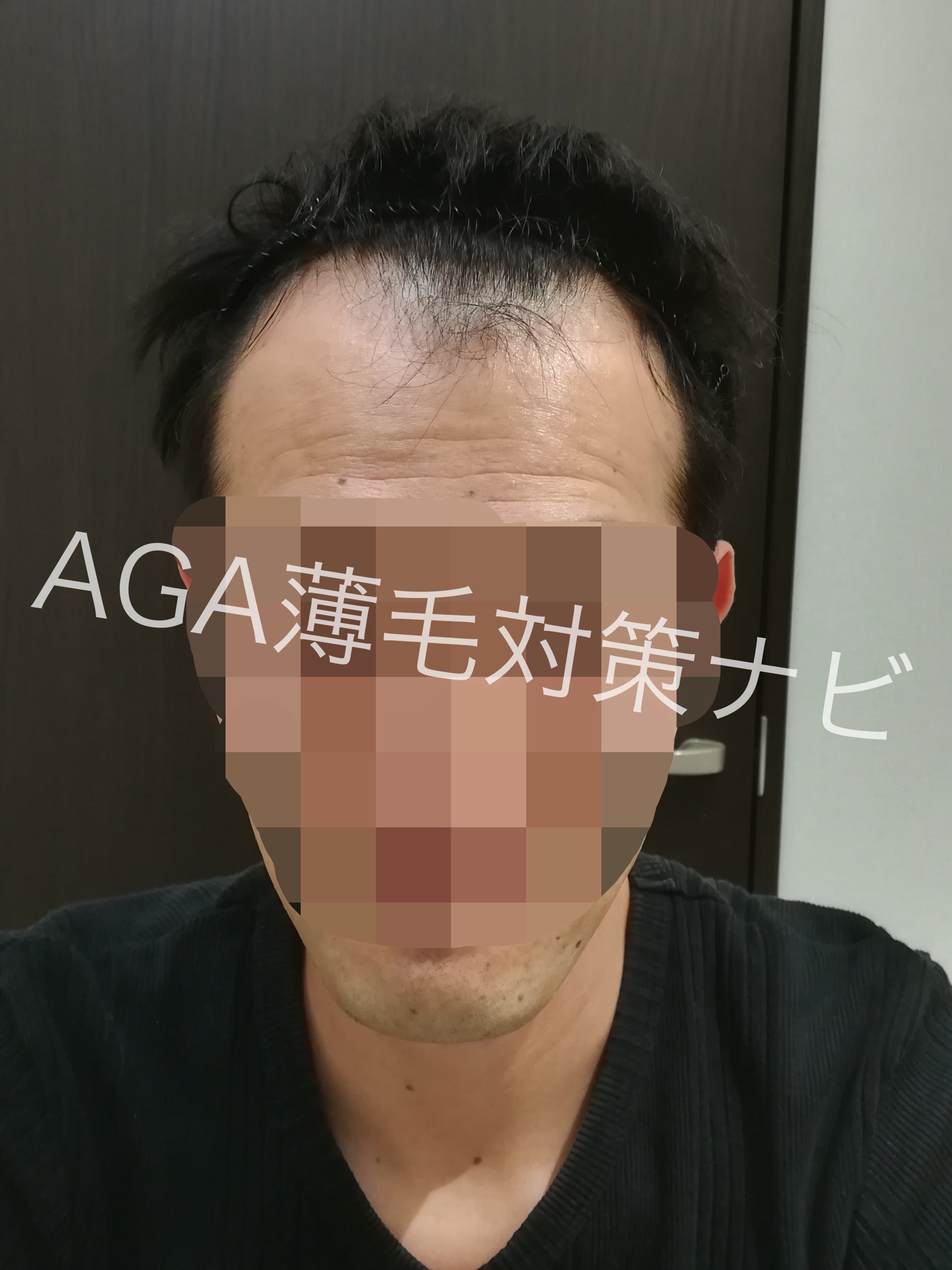 【体験談】AGAスキンクリニックの無料カウンセリング診断を体験!
