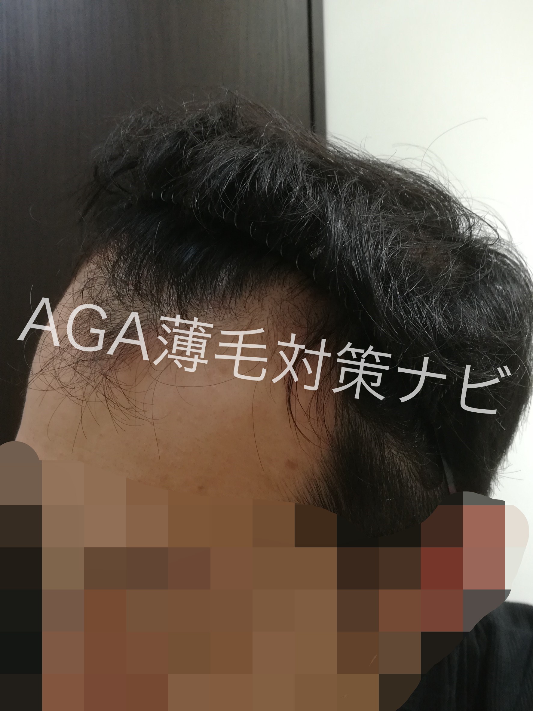 【体験談】AGAスキンクリニックの無料カウンセリング診断を体験!