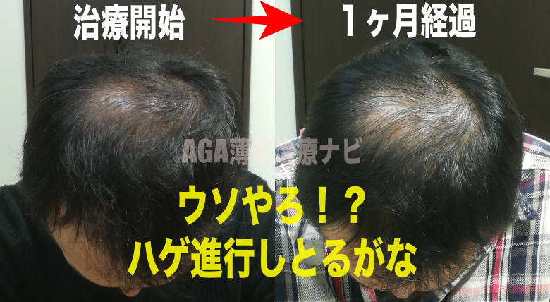【治療２回目】初期脱毛の期間や量を報告《AGA治療日記１ヶ月目》