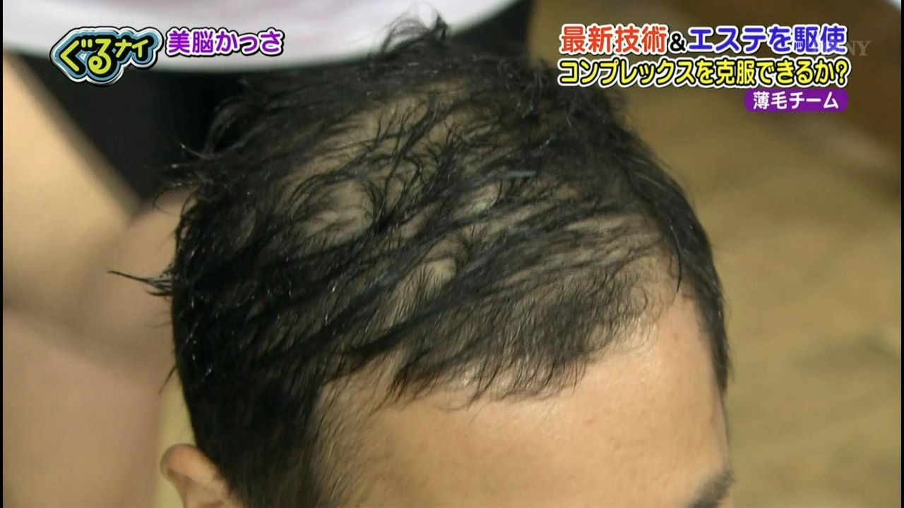 ナイナイ岡村隆史は薄毛・AGA治療で髪が復活！育毛方法や病院を暴露！